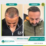 Antalya Saç ekimi